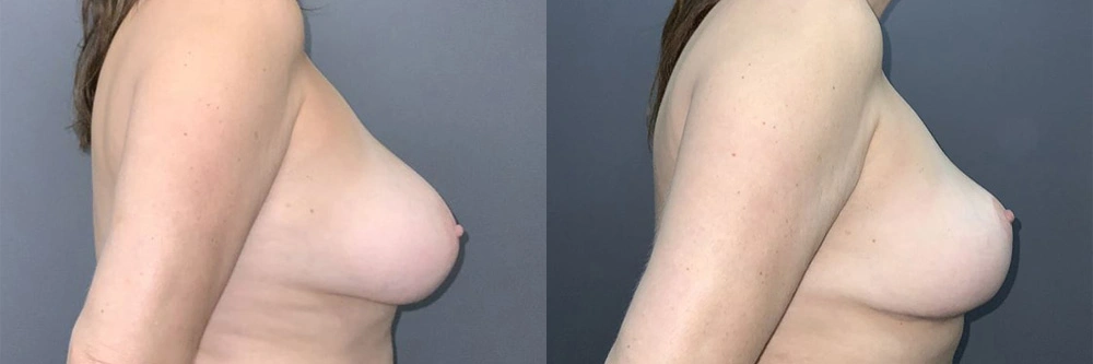 Real Patient Results in Newport Beach, CA. Preformed by Semira Bayait, MD, FACS.