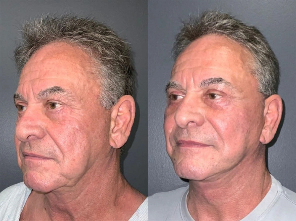 Real Patient Results in Newport Beach, CA. Preformed by Semira Bayait, MD, FACS.