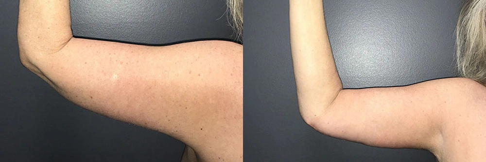 Real Patient Results in Newport Beach, CA. Preformed by Semira Bayait, MD, FACS.
