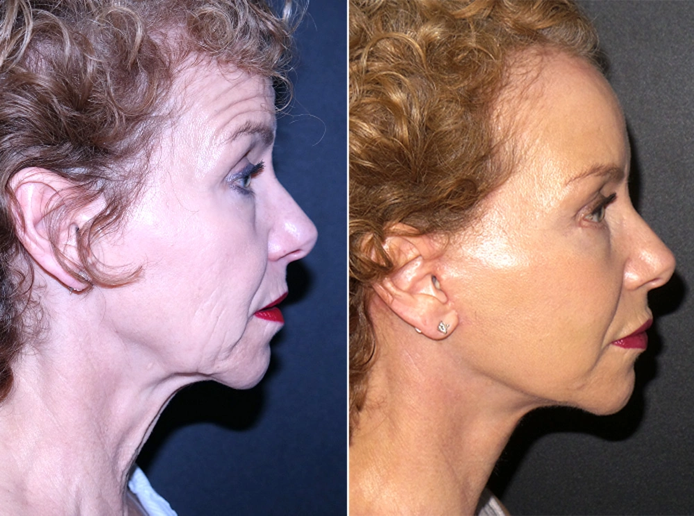 Real Patient Results in Newport Beach, CA. Preformed by Semira Bayait, MD, FACS.