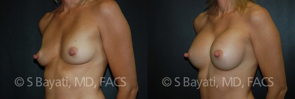 Real Patient Results in Newport Beach, CA. Preformed by Semira Bayait, MD, FACS.