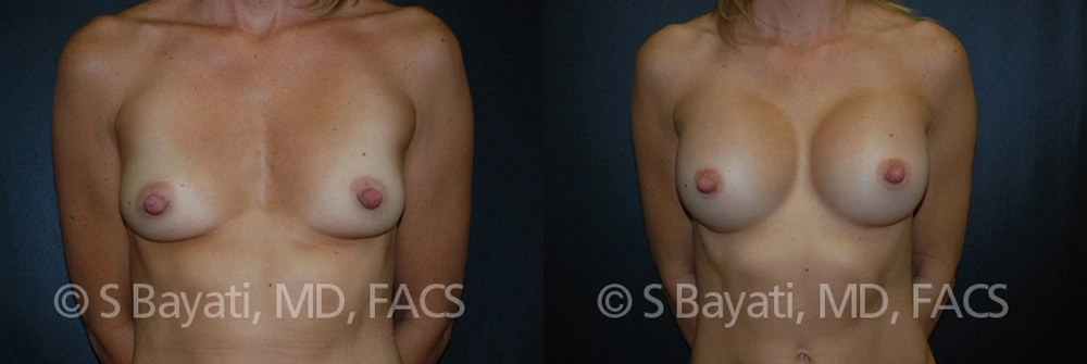 Real Patient Results in Newport Beach, CA. Preformed by Semira Bayait, MD, FACS.