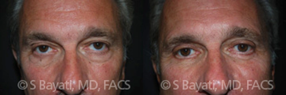 Real Patient Results in Newport Beach, CA. Preformed by Semira Bayait, MD, FACS.