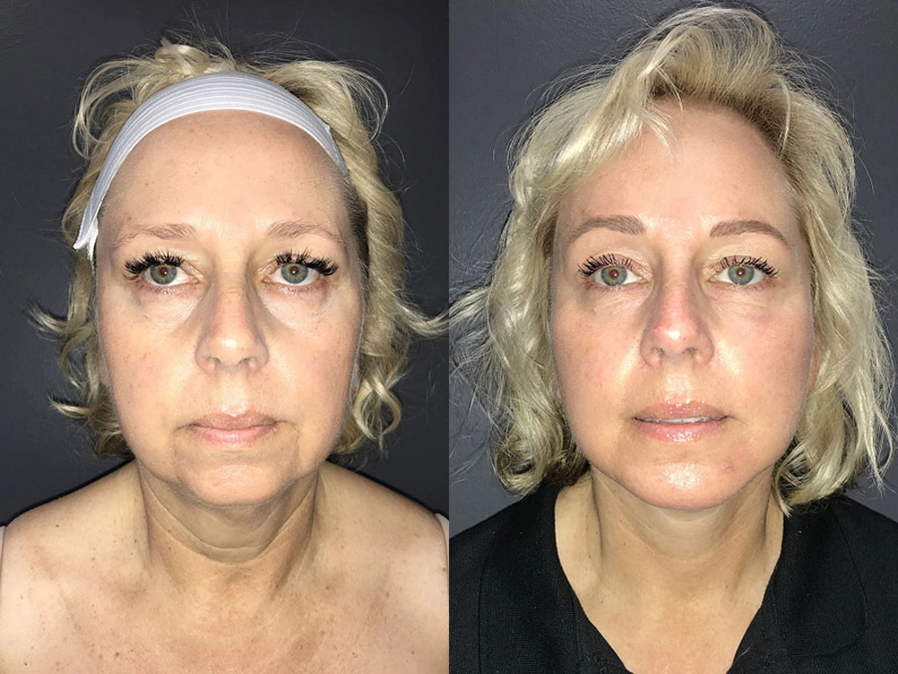 Real Patient Results in Newport Beach, CA. Preformed by Semira Bayait, MD, FACS.