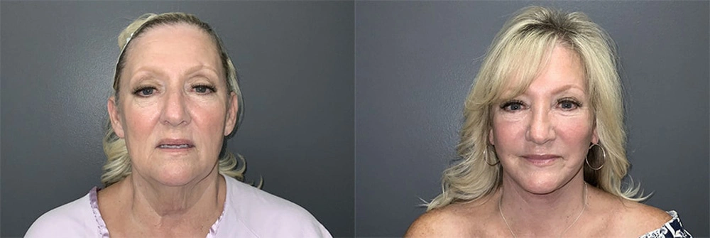 Real Patient Results in Newport Beach, CA. Preformed by Semira Bayait, MD, FACS.