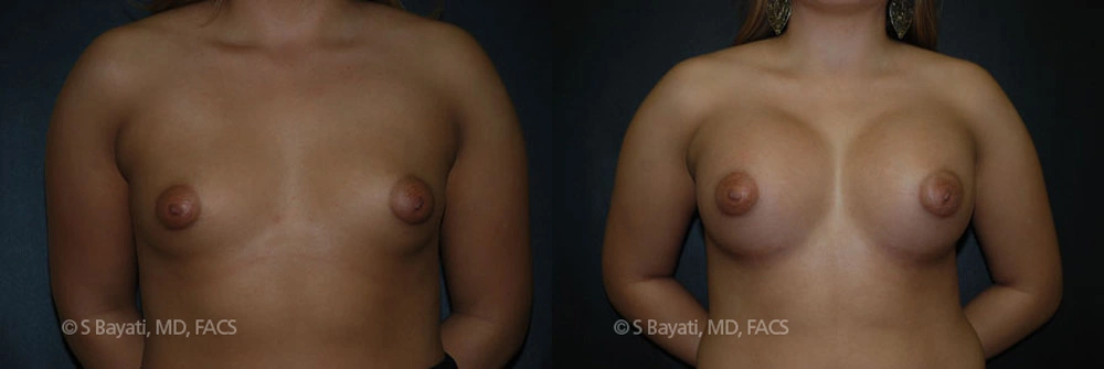 Real Patient Results in Newport Beach, CA. Preformed by Semira Bayait, MD, FACS.