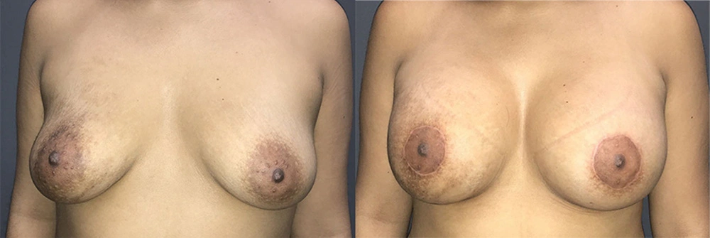 Real Patient Results in Newport Beach, CA. Preformed by Semira Bayait, MD, FACS.