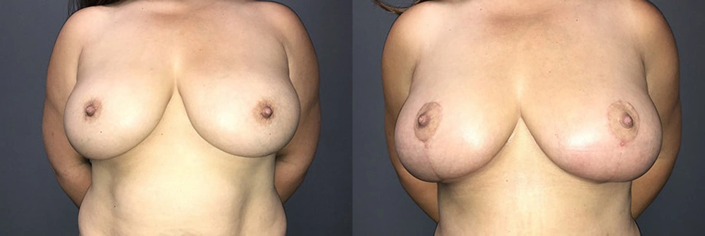 Real Patient Results in Newport Beach, CA. Preformed by Semira Bayait, MD, FACS.