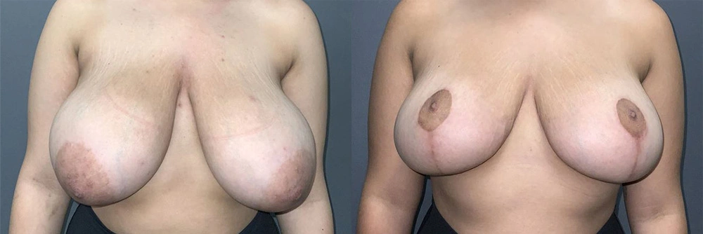 Real Patient Results in Newport Beach, CA. Preformed by Semira Bayait, MD, FACS.