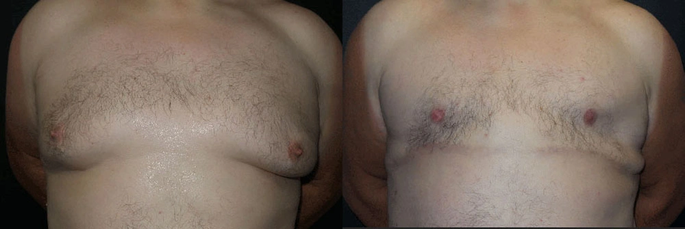 Real Patient Results in Newport Beach, CA. Preformed by Semira Bayait, MD, FACS.