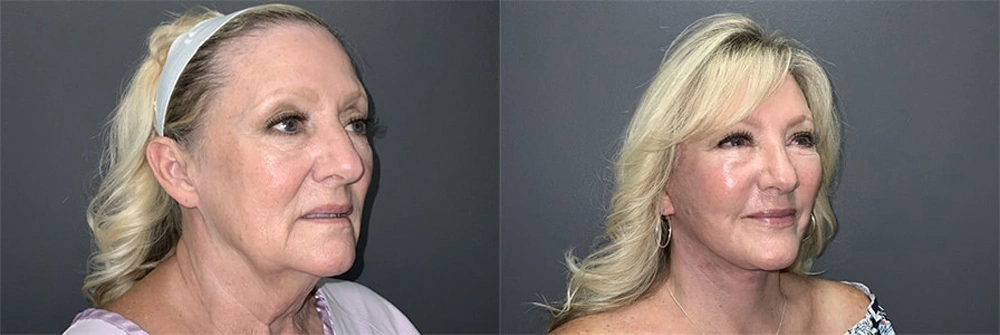 Real Patient Results in Newport Beach, CA. Preformed by Semira Bayait, MD, FACS.