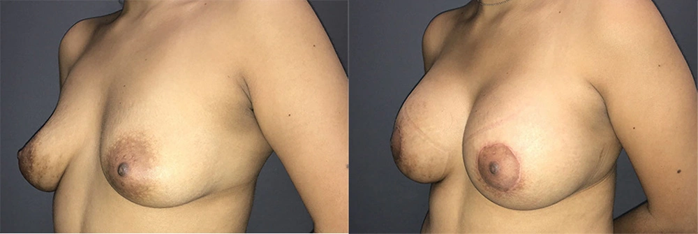 Real Patient Results in Newport Beach, CA. Preformed by Semira Bayait, MD, FACS.