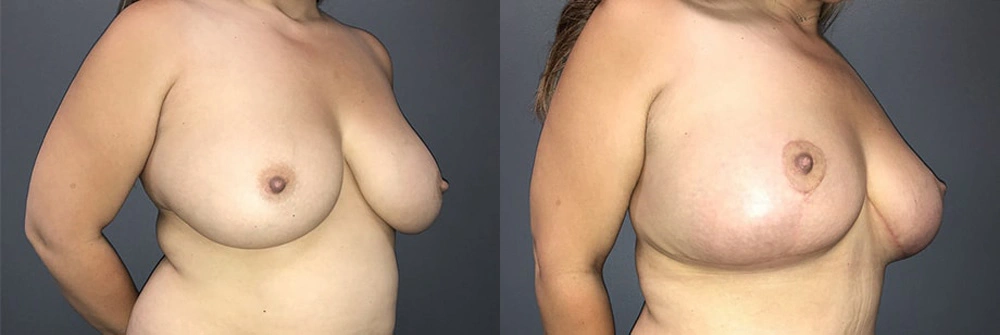 Real Patient Results in Newport Beach, CA. Preformed by Semira Bayait, MD, FACS.