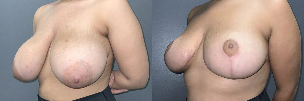 Real Patient Results in Newport Beach, CA. Preformed by Semira Bayait, MD, FACS.