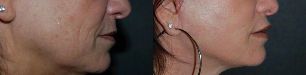 Real Patient Results in Newport Beach, CA. Preformed by Semira Bayait, MD, FACS.