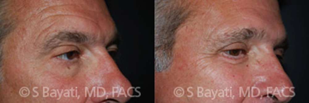Real Patient Results in Newport Beach, CA. Preformed by Semira Bayait, MD, FACS.