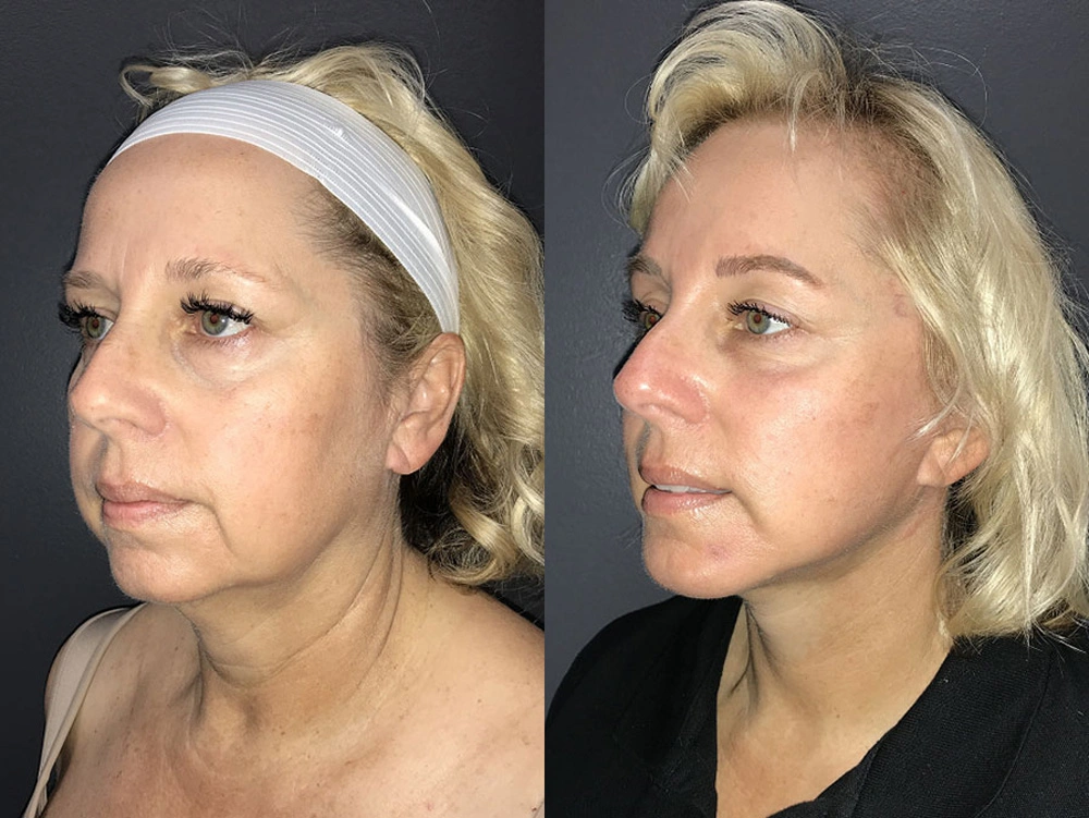 Real Patient Results in Newport Beach, CA. Preformed by Semira Bayait, MD, FACS.