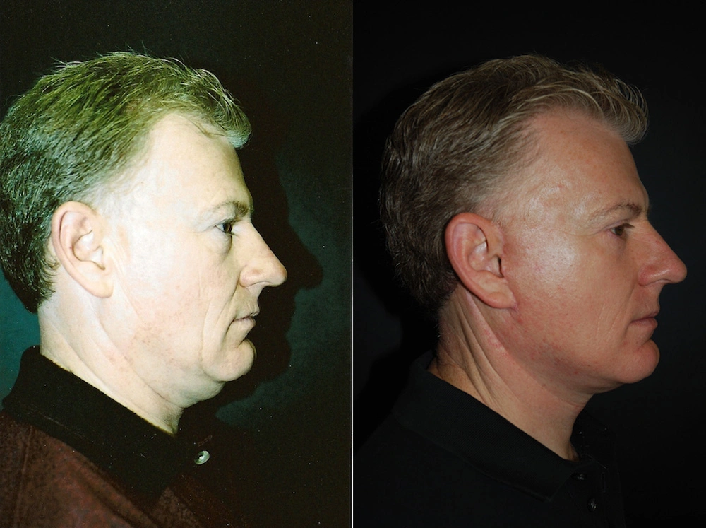 Real Patient Results in Newport Beach, CA. Preformed by Semira Bayait, MD, FACS.