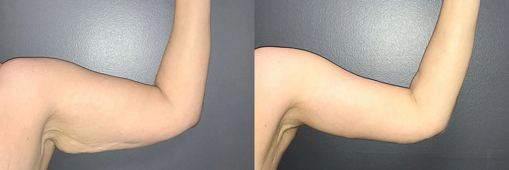 Real Patient Results in Newport Beach, CA. Preformed by Semira Bayait, MD, FACS.