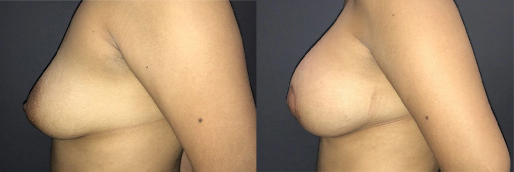Real Patient Results in Newport Beach, CA. Preformed by Semira Bayait, MD, FACS.