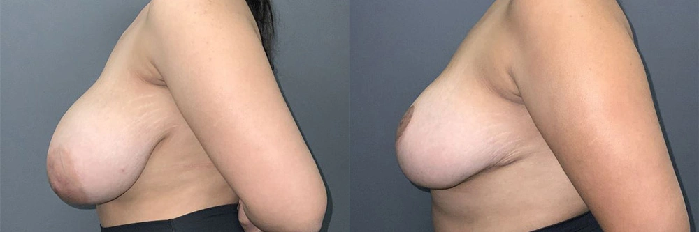 Real Patient Results in Newport Beach, CA. Preformed by Semira Bayait, MD, FACS.