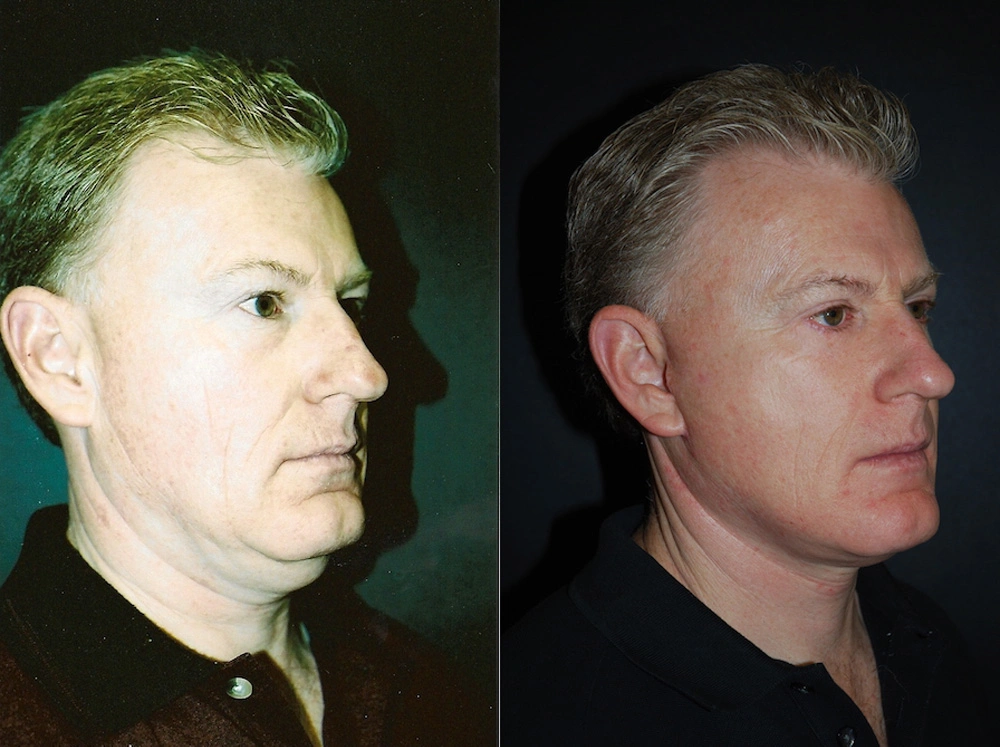 Real Patient Results in Newport Beach, CA. Preformed by Semira Bayait, MD, FACS.