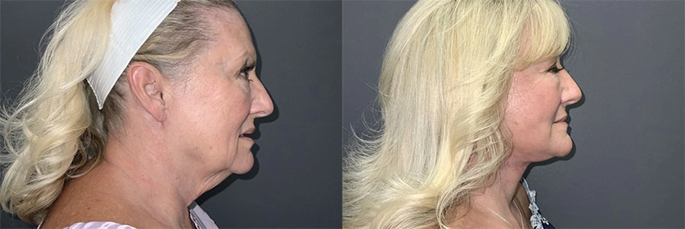 Real Patient Results in Newport Beach, CA. Preformed by Semira Bayait, MD, FACS.