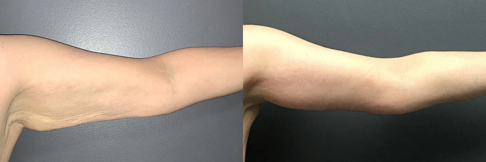 Real Patient Results in Newport Beach, CA. Preformed by Semira Bayait, MD, FACS.