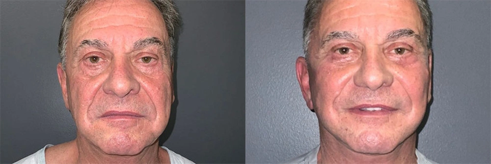 Real Patient Results in Newport Beach, CA. Preformed by Semira Bayait, MD, FACS.