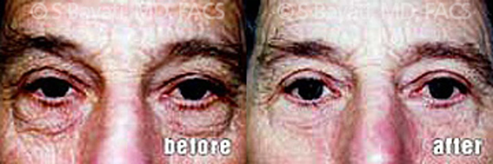 Real Patient Results in Newport Beach, CA. Preformed by Semira Bayait, MD, FACS.