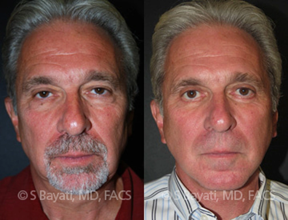 Real Patient Results in Newport Beach, CA. Preformed by Semira Bayait, MD, FACS.