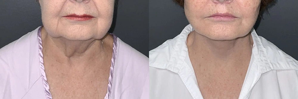 Real Patient Results in Newport Beach, CA. Preformed by Semira Bayait, MD, FACS.