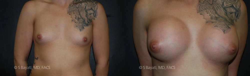 Real Patient Results in Newport Beach, CA. Preformed by Semira Bayait, MD, FACS.