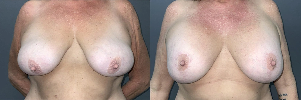 Real Patient Results in Newport Beach, CA. Preformed by Semira Bayait, MD, FACS.