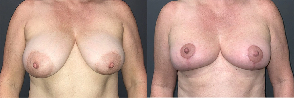 Real Patient Results in Newport Beach, CA. Preformed by Semira Bayait, MD, FACS.