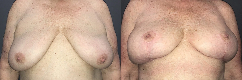 Real Patient Results in Newport Beach, CA. Preformed by Semira Bayait, MD, FACS.