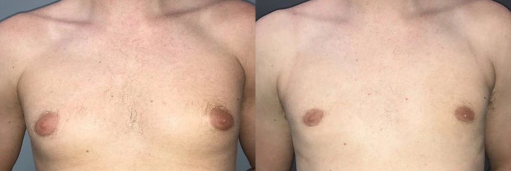 Real Patient Results in Newport Beach, CA. Preformed by Semira Bayait, MD, FACS.
