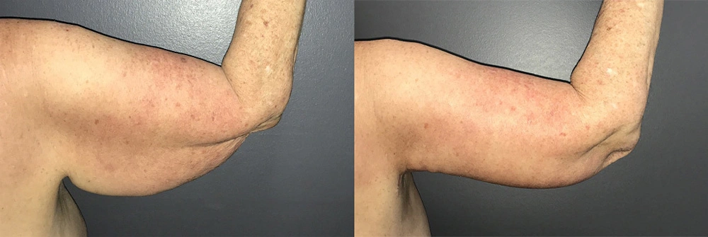 Real Patient Results in Newport Beach, CA. Preformed by Semira Bayait, MD, FACS.