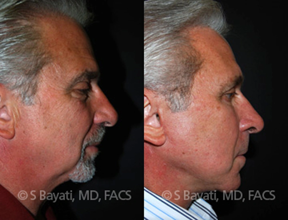Real Patient Results in Newport Beach, CA. Preformed by Semira Bayait, MD, FACS.