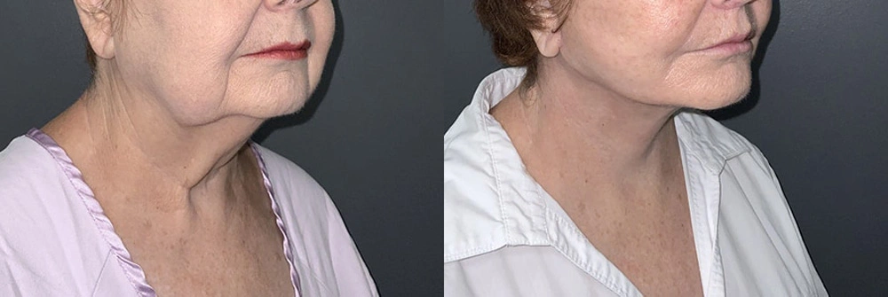 Real Patient Results in Newport Beach, CA. Preformed by Semira Bayait, MD, FACS.