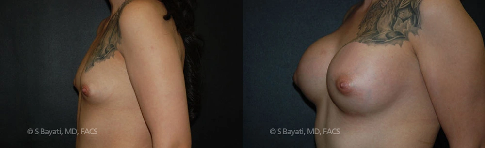 Real Patient Results in Newport Beach, CA. Preformed by Semira Bayait, MD, FACS.