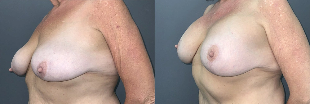 Real Patient Results in Newport Beach, CA. Preformed by Semira Bayait, MD, FACS.