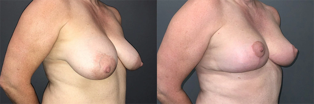 Real Patient Results in Newport Beach, CA. Preformed by Semira Bayait, MD, FACS.