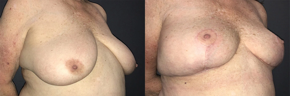 Real Patient Results in Newport Beach, CA. Preformed by Semira Bayait, MD, FACS.