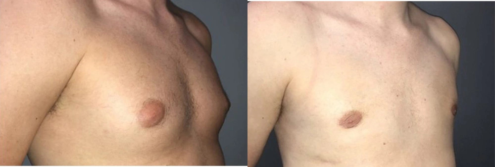 Real Patient Results in Newport Beach, CA. Preformed by Semira Bayait, MD, FACS.