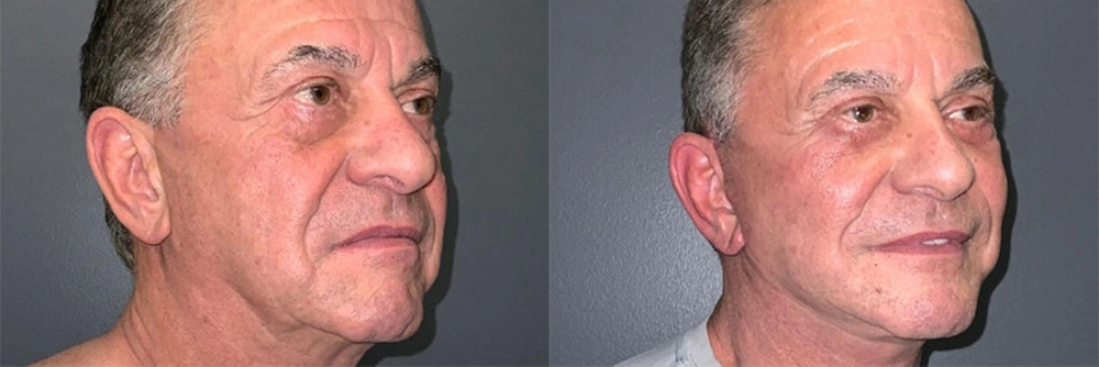 Real Patient Results in Newport Beach, CA. Preformed by Semira Bayait, MD, FACS.