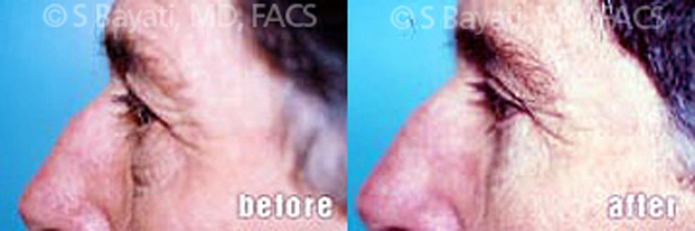 Real Patient Results in Newport Beach, CA. Preformed by Semira Bayait, MD, FACS.