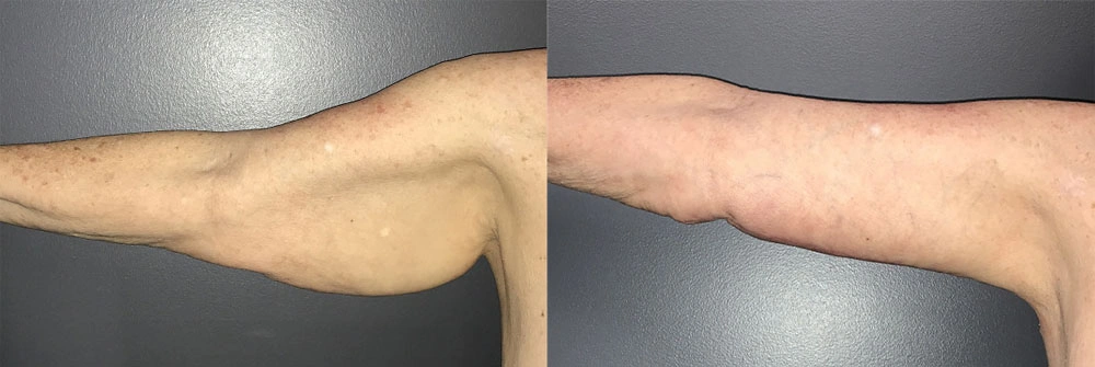 Real Patient Results in Newport Beach, CA. Preformed by Semira Bayait, MD, FACS.