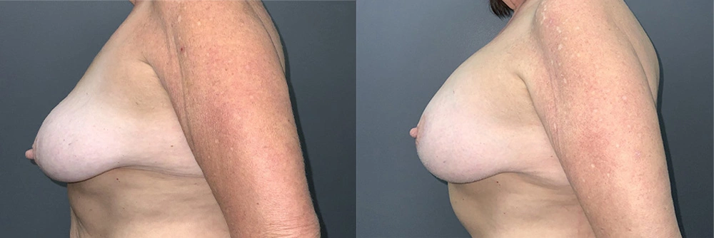 Real Patient Results in Newport Beach, CA. Preformed by Semira Bayait, MD, FACS.