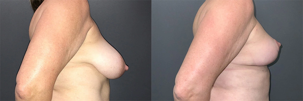 Real Patient Results in Newport Beach, CA. Preformed by Semira Bayait, MD, FACS.